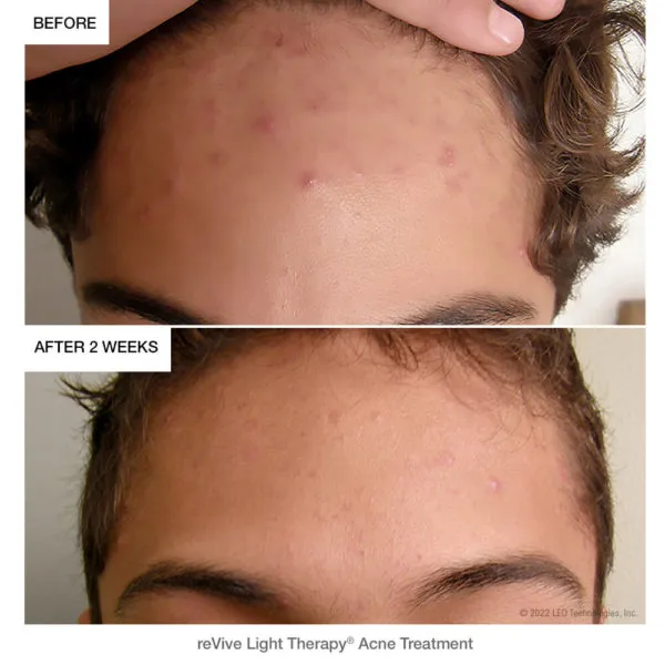 Lux Collection dpl IIa – LED Light Wrinkle Reduction & Acne Treatment Panel